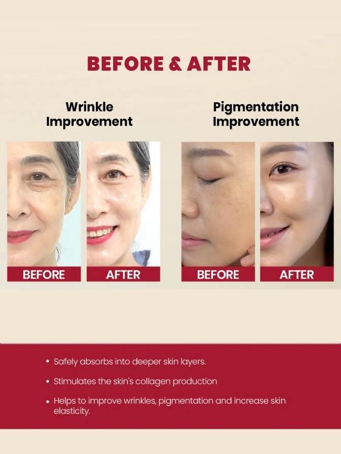 Before and after comparison of wrinkle and pigmentation improvement on a person's face.