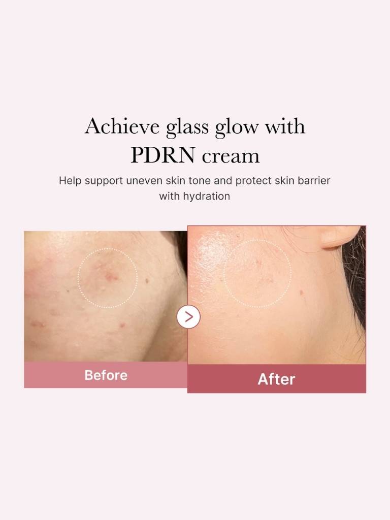 Before and after comparison of skin with PDRN cream application on a white background