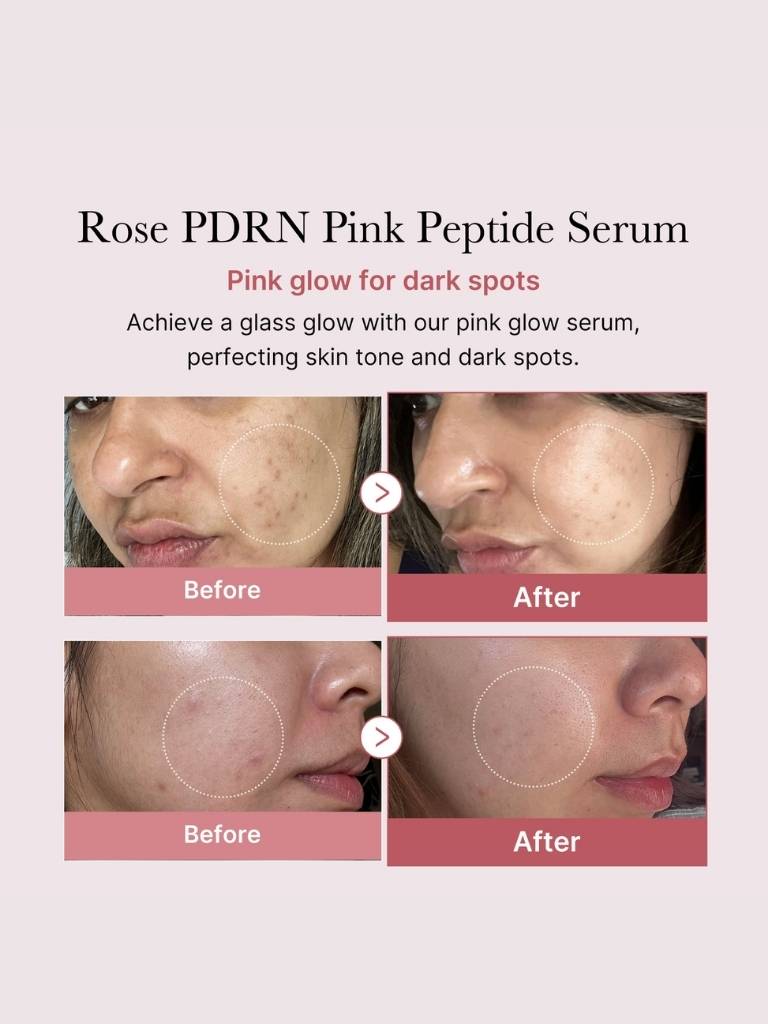 Advertisement for Rose PDRN Pink Peptide Serum showing before and after effects on skin.