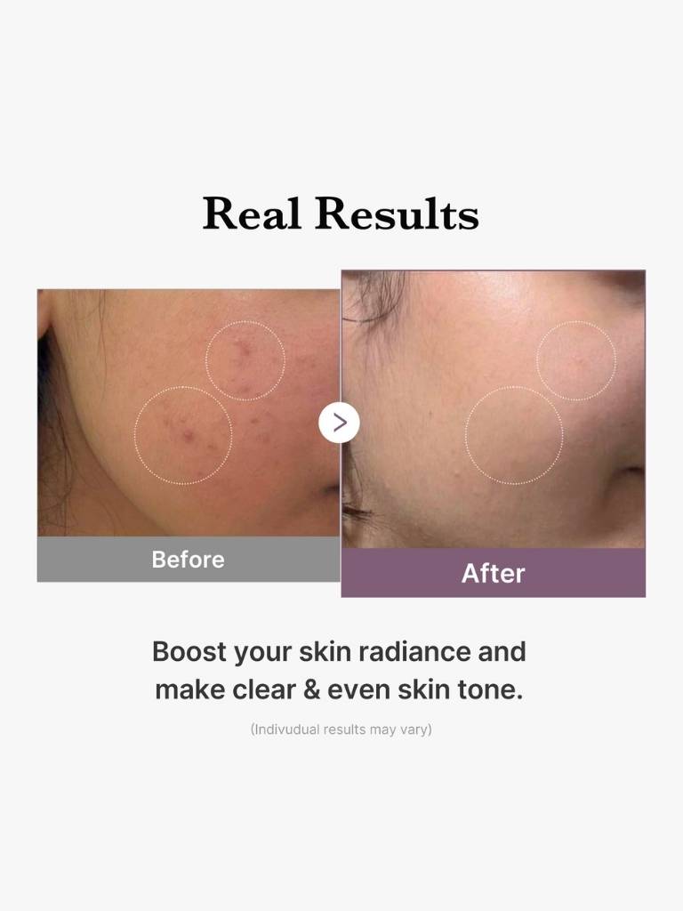 Before and after comparison of skin with blemishes, showing a clear and even skin tone.