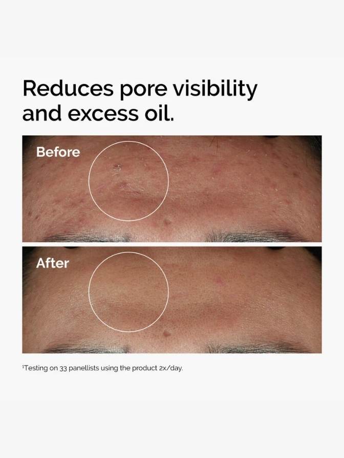 Before and after comparison of skin with text indicating pore reduction and oil control.