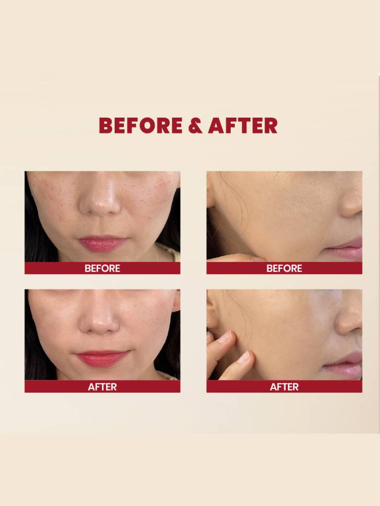 Before and after skin comparison on a beige background with 'Before & After' text.