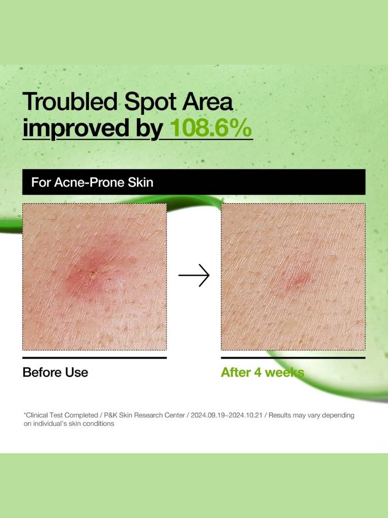 Before and after comparison of acne-prone skin treatment on a green background