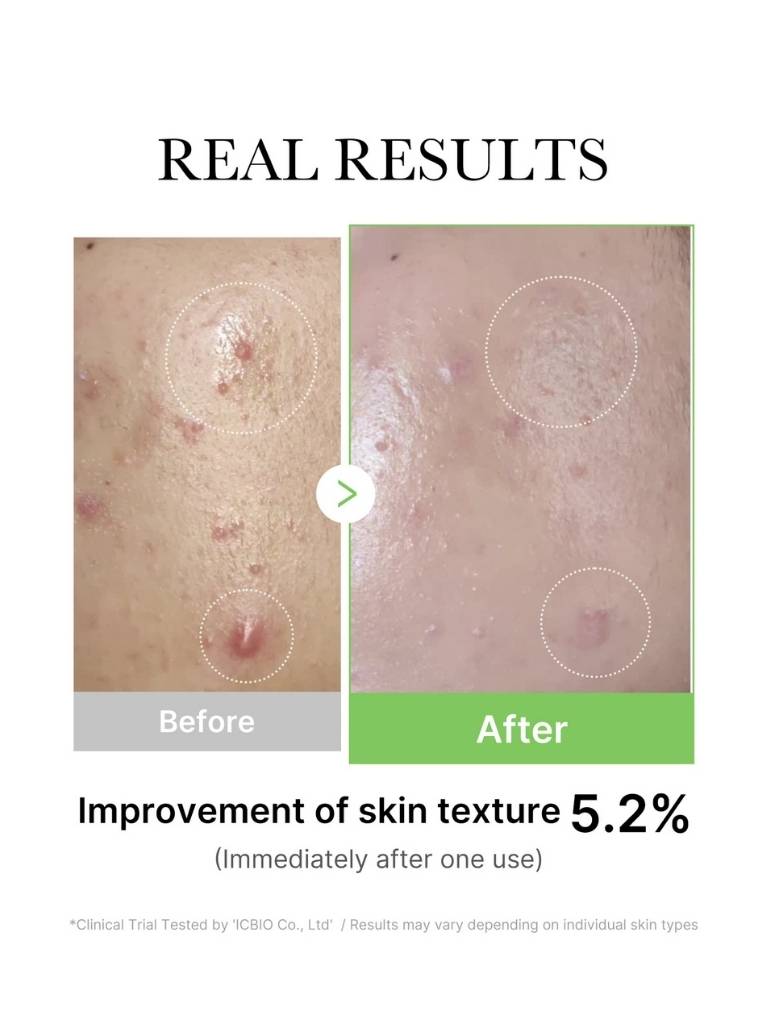 Before and after comparison of skin texture improvement with text indicating a 5.2% improvement.