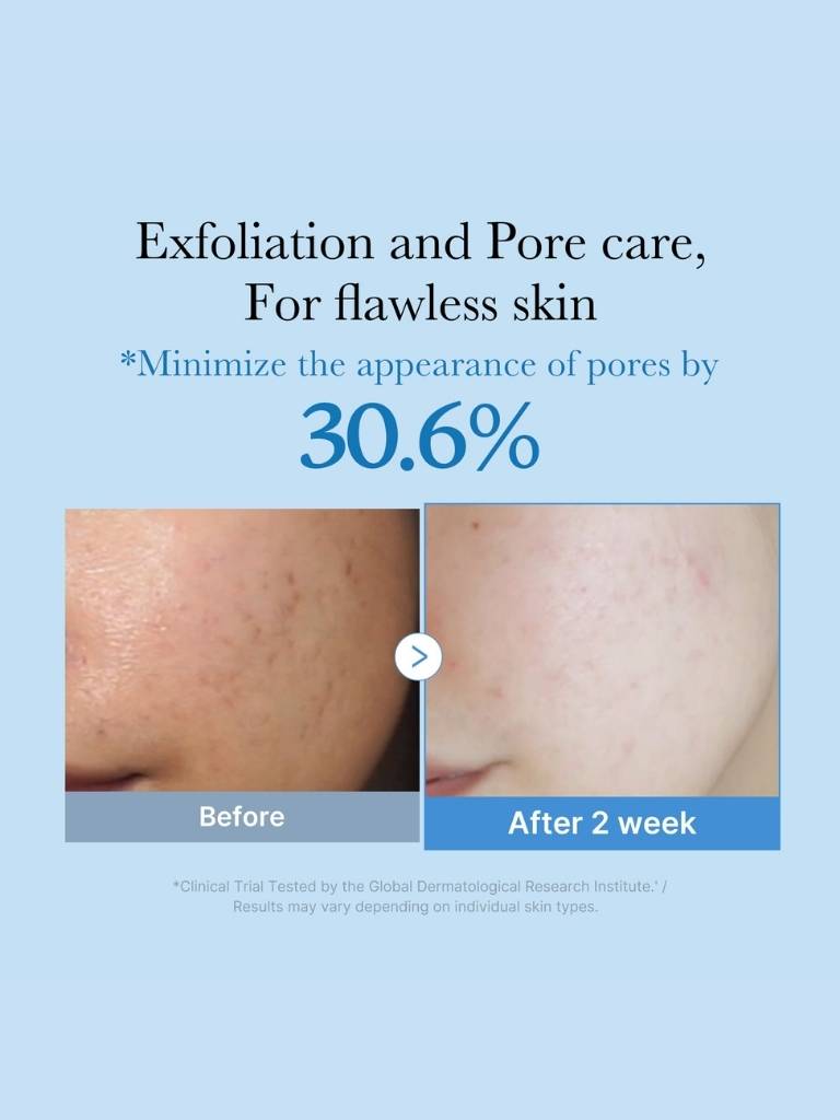 Before and after skin care treatment showing exfoliation and pore care results on a blue background.