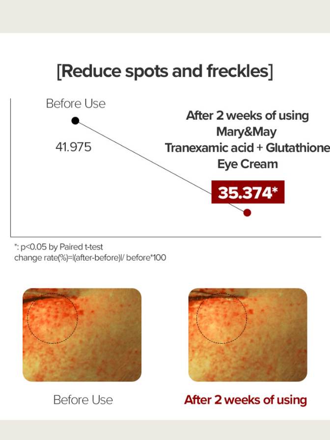 Before and after comparison of skin spots and freckles using Mary&May eye cream.