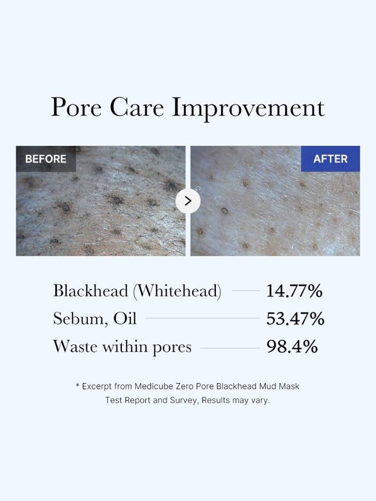 Before and after comparison of pore care improvement with text on blackhead, whitehead, sebum, oil, and waste within pores.