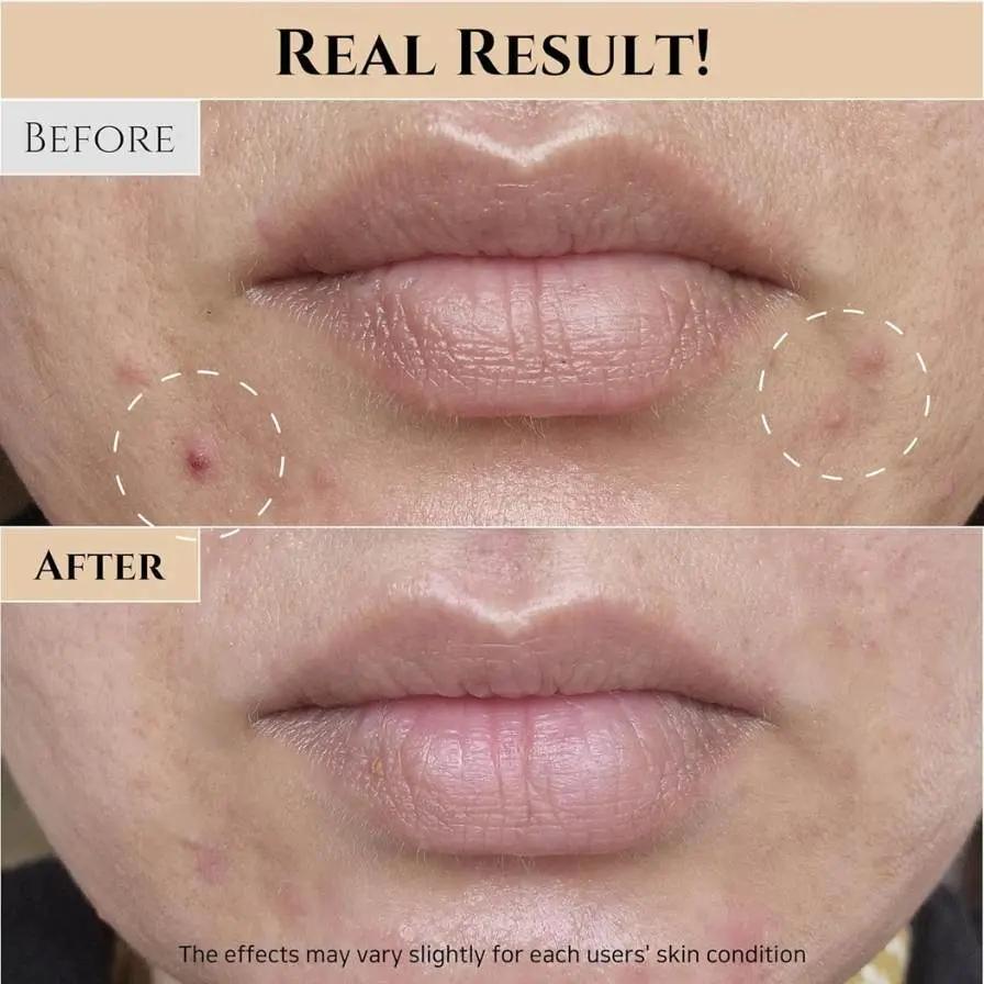 Before and after comparison of lips with visible improvement in skin texture and condition.