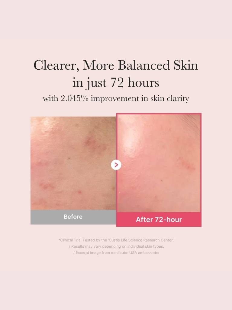 Before and after comparison of skin clarity with text on a light pink background