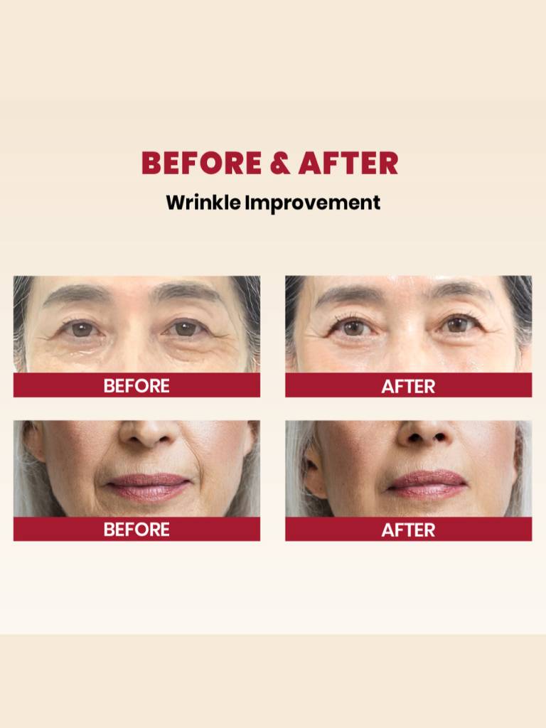 Before and after comparison of wrinkle improvement on a person's face.
