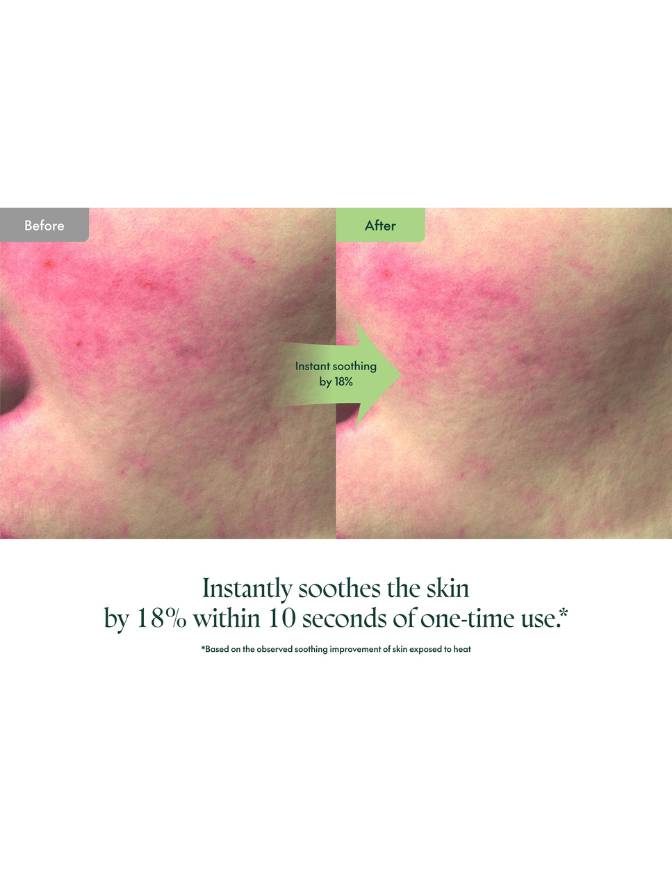Before and after comparison of skin with redness, showing a 10-second treatment's effect.