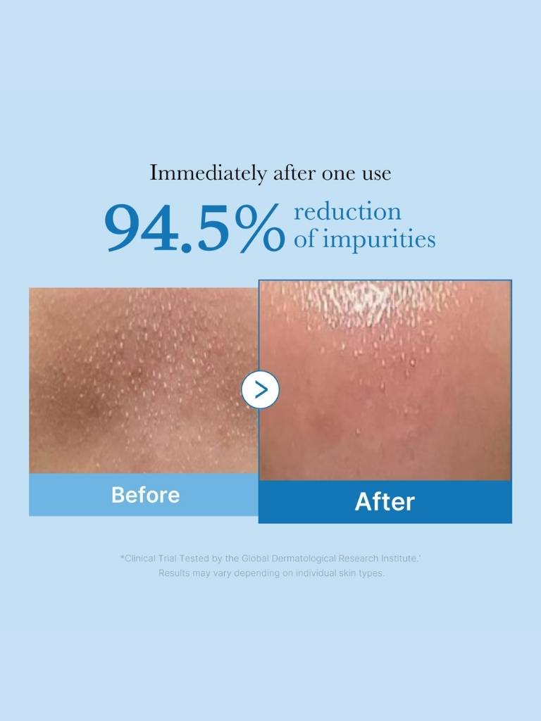 Before and after comparison of skin impurities reduction with text on a blue background