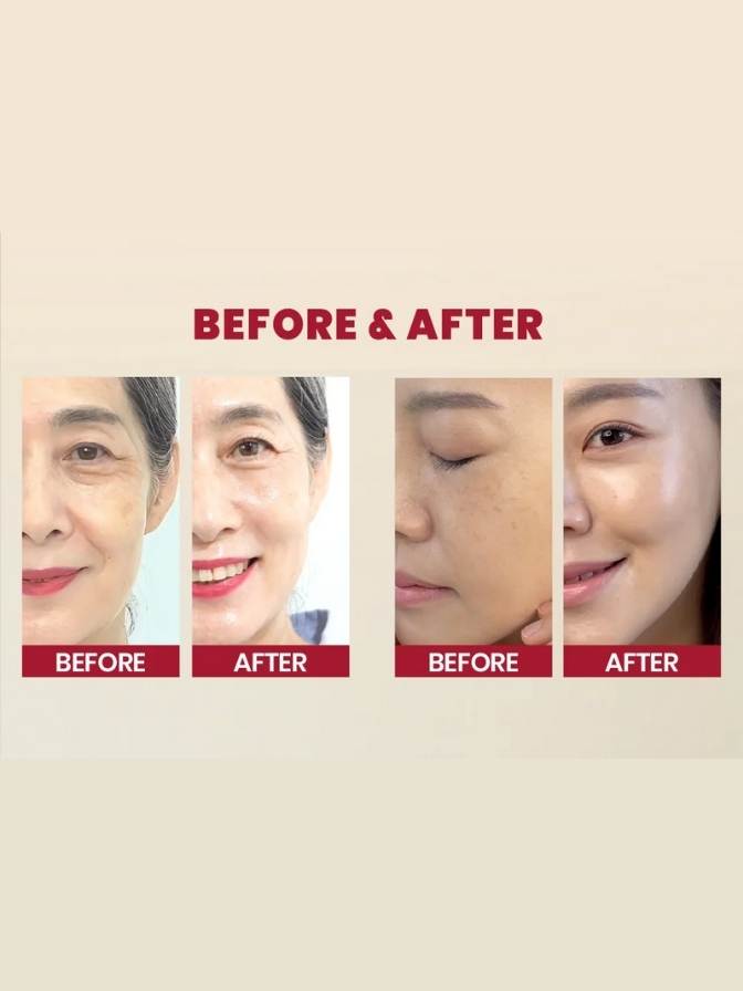 Before and after comparison of facial skin treatment on a beige background