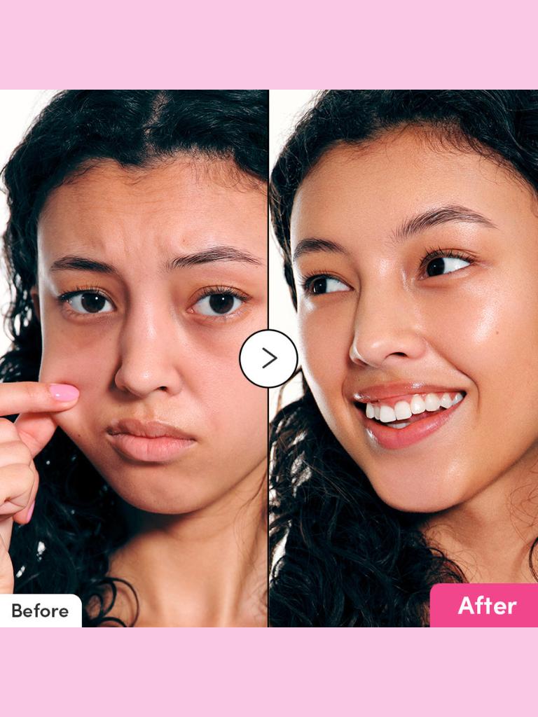 Before and after comparison of a woman's face with visible skin improvement.