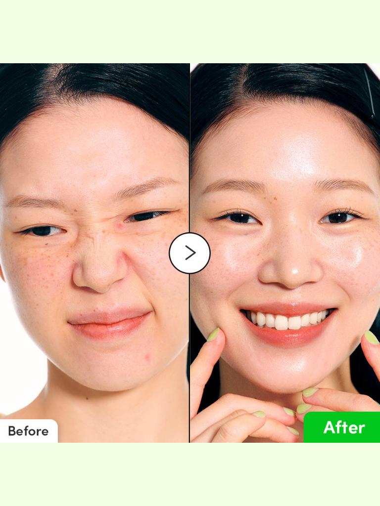 Before and after comparison of a person's face with visible skin improvement.
