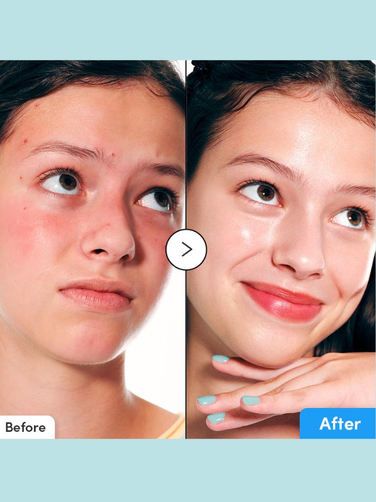 Before and after comparison of a person's face with visible skin improvement.