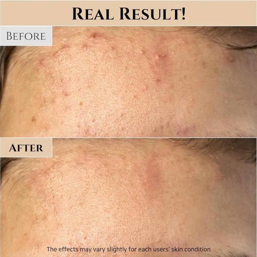 Before and after comparison of skin treatment showing reduced acne scars.