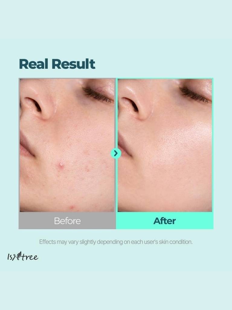 Before and after comparison of skin treatment with a visible improvement.