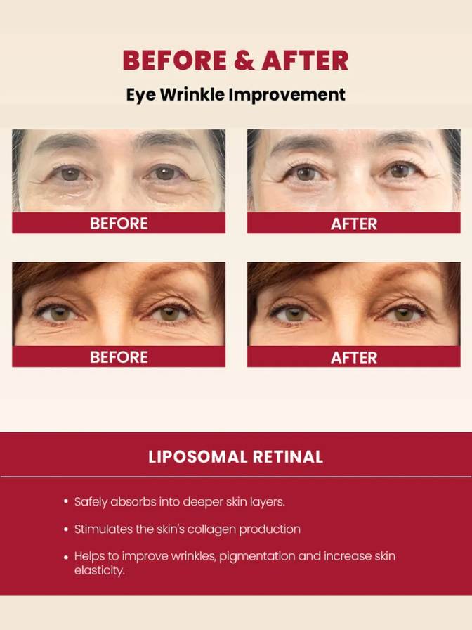 Before and after comparison of eye wrinkles using liposomal retinal treatment.