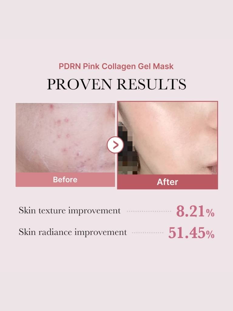 Before and after comparison of skin texture improvement using PDRN Pink Collagen Gel Mask.