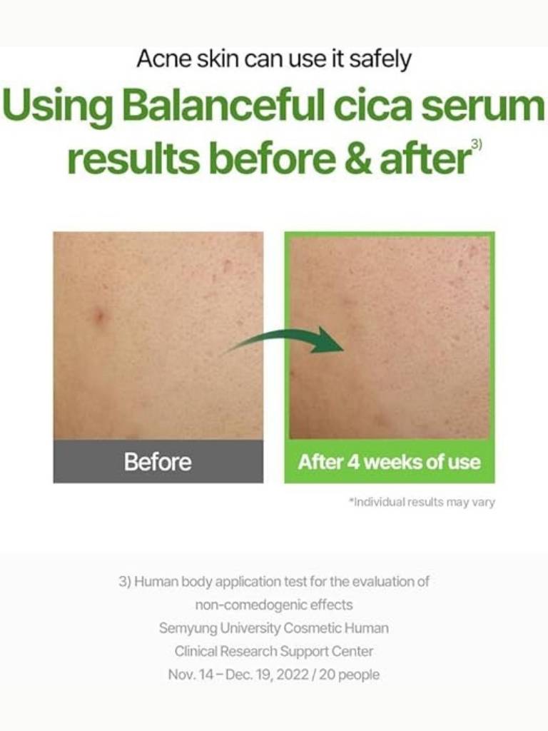 Advertisement for Balanceful cica serum showing before and after effects on acne skin.
