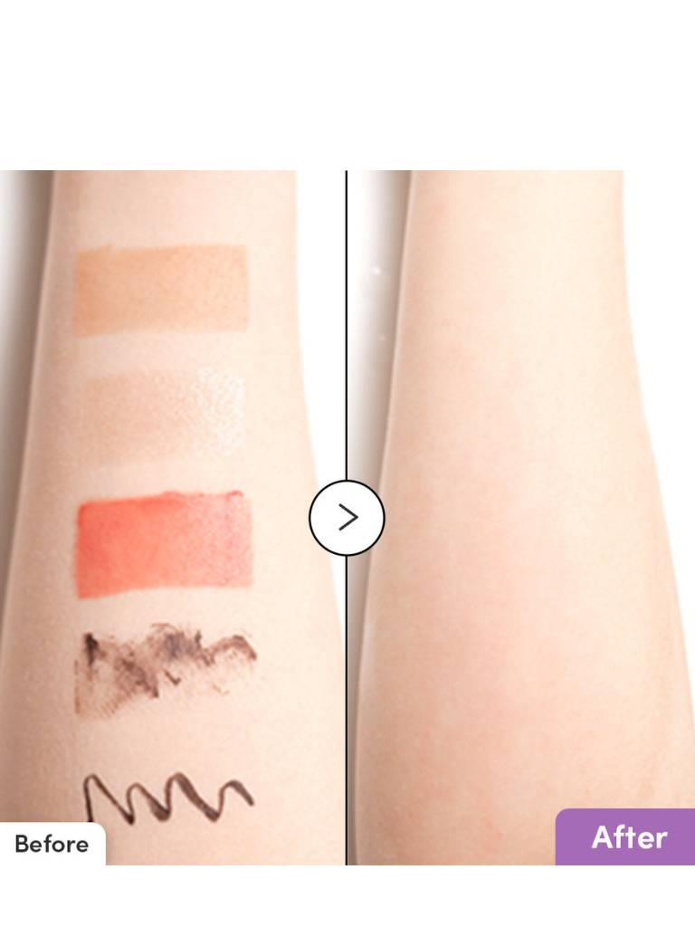 Before and after comparison of a tattoo removal process on a person's arm.