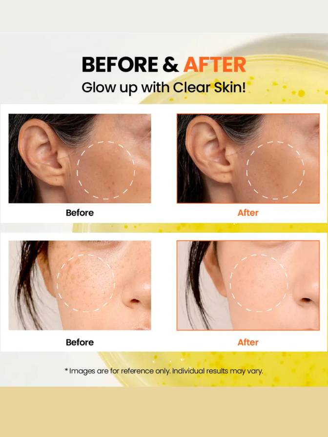 Before and after comparison of clear skin on a person's face with text 'Glow up with Clear Skin!'.